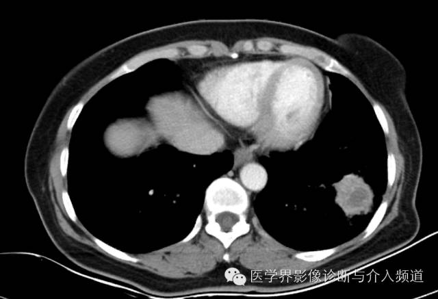 【病例】左下肺硬化性血管瘤1例CT影像表现