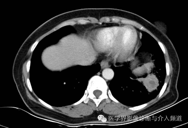 【病例】左下肺硬化性血管瘤1例CT影像表现