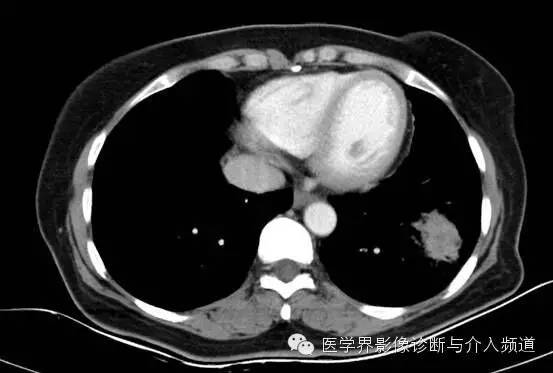 【病例】左下肺硬化性血管瘤1例CT影像表现