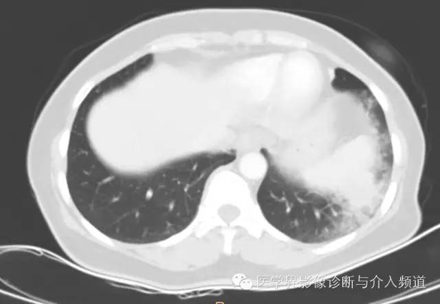 【病例】左下肺硬化性血管瘤1例CT影像表现