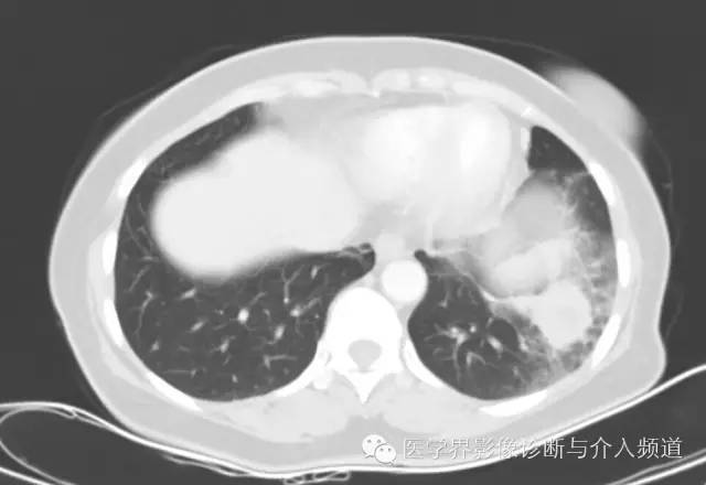 【病例】左下肺硬化性血管瘤1例CT影像表现