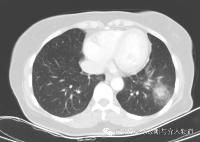【病例】左下肺硬化性血管瘤1例CT影像表现