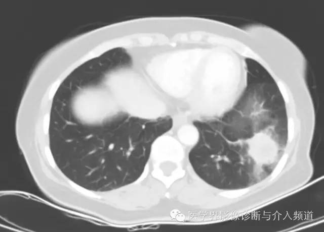 【病例】左下肺硬化性血管瘤1例CT影像表现