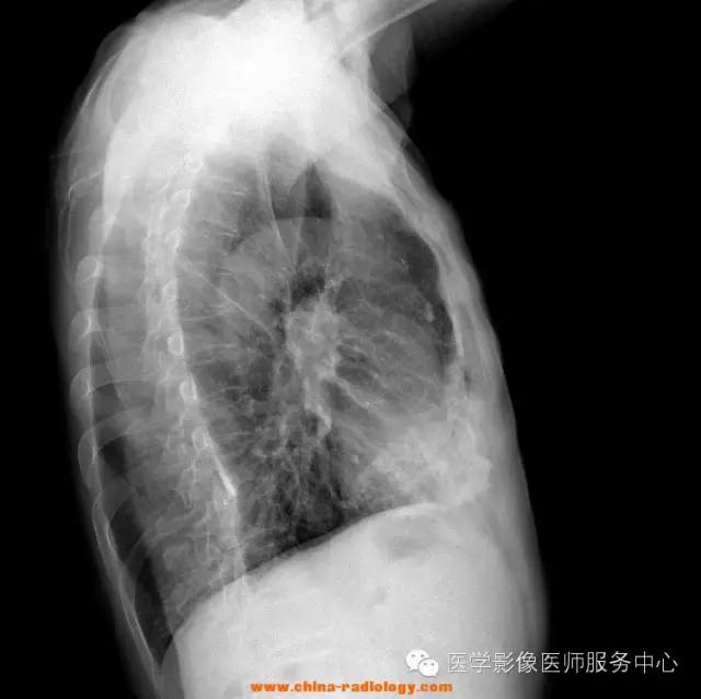 【病例】壁层胸膜钙化1例X线