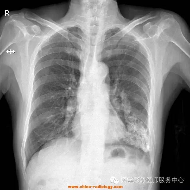 【病例】壁层胸膜钙化1例X线