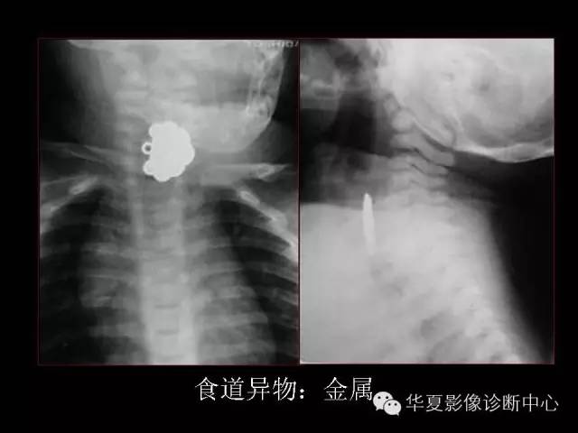 【PPT】食道常见疾病影像诊断