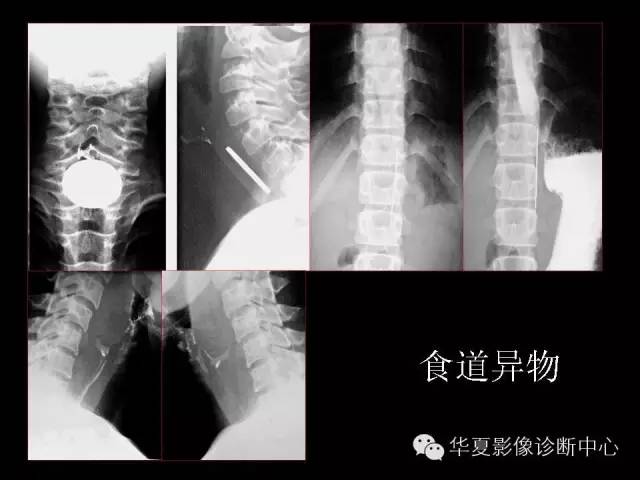 【PPT】食道常见疾病影像诊断