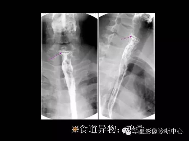 【PPT】食道常见疾病影像诊断