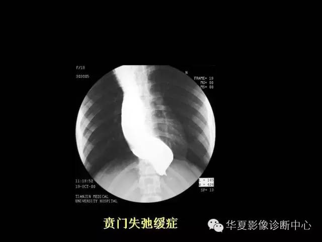 【PPT】食道常见疾病影像诊断