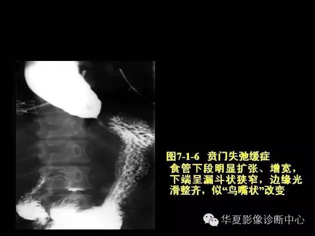 【PPT】食道常见疾病影像诊断