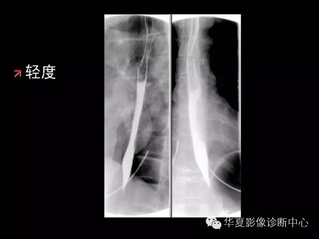 【PPT】食道常见疾病影像诊断