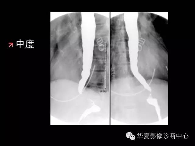 【PPT】食道常见疾病影像诊断