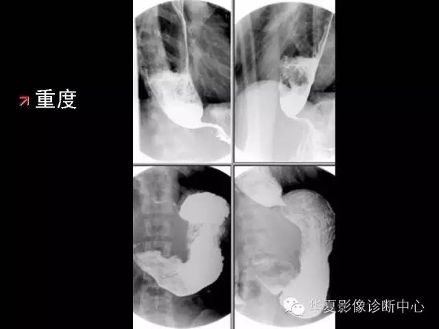 【PPT】食道常见疾病影像诊断