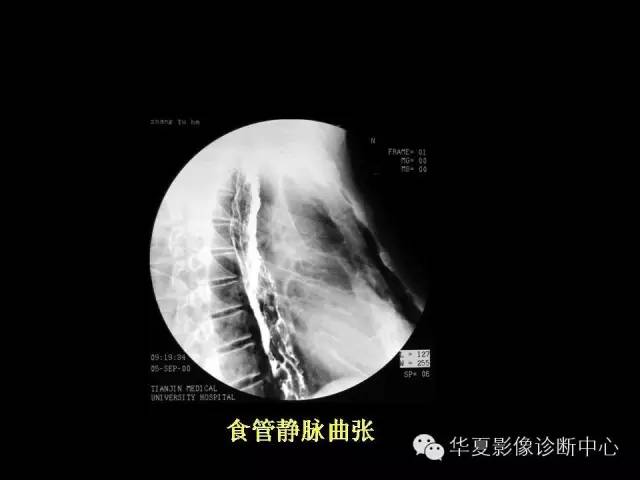 【PPT】食道常见疾病影像诊断