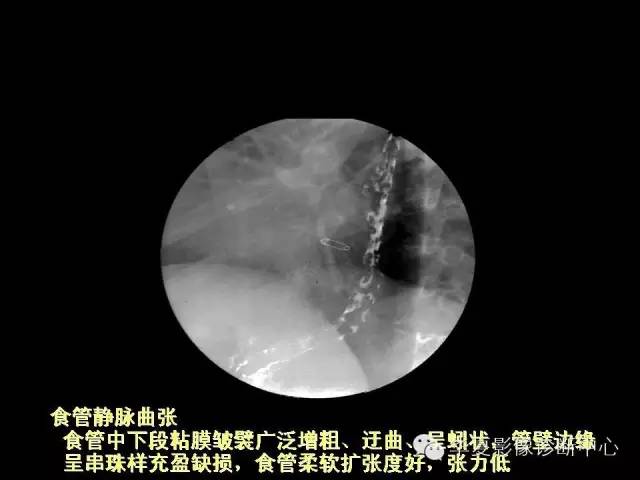 【PPT】食道常见疾病影像诊断