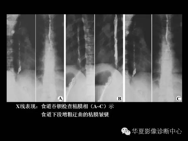 【PPT】食道常见疾病影像诊断