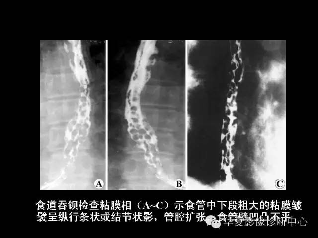 【PPT】食道常见疾病影像诊断