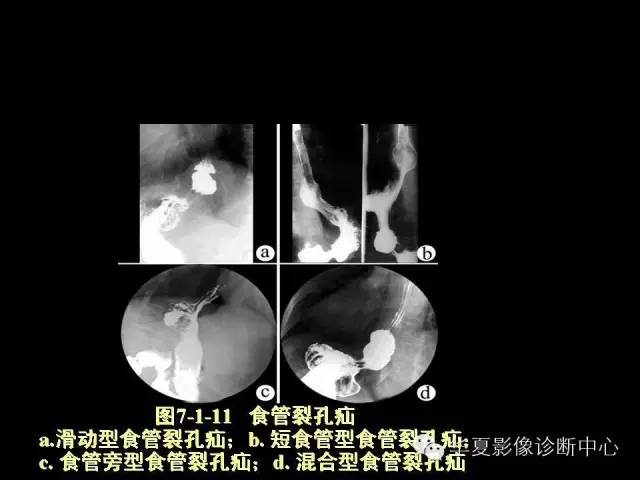 【PPT】食道常见疾病影像诊断