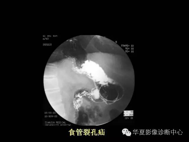 【PPT】食道常见疾病影像诊断