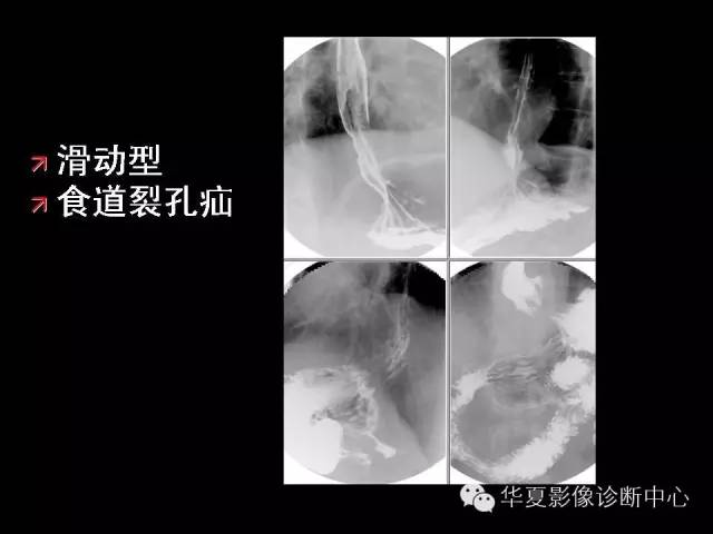 【PPT】食道常见疾病影像诊断