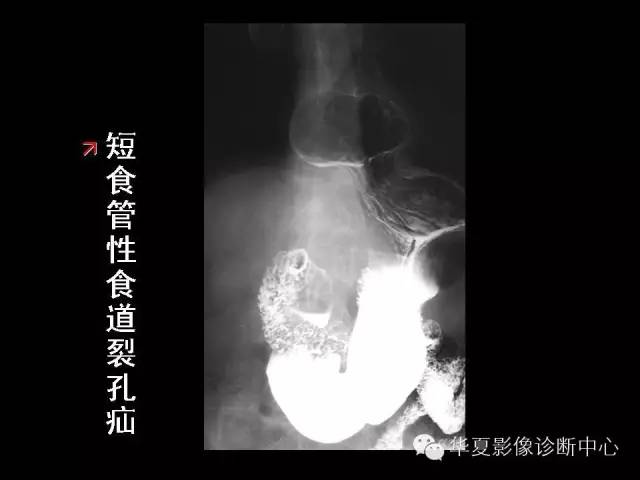 【PPT】食道常见疾病影像诊断