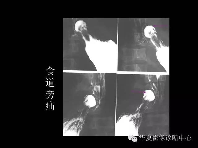【PPT】食道常见疾病影像诊断