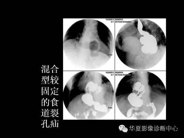 【PPT】食道常见疾病影像诊断