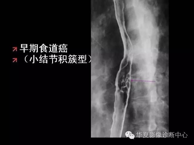 【PPT】食道常见疾病影像诊断