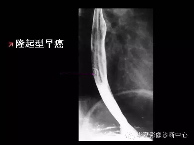 【PPT】食道常见疾病影像诊断