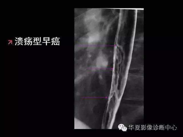 【PPT】食道常见疾病影像诊断