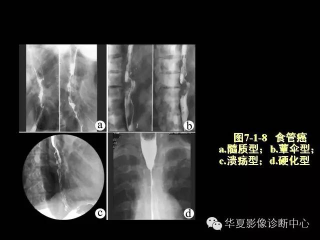 【PPT】食道常见疾病影像诊断