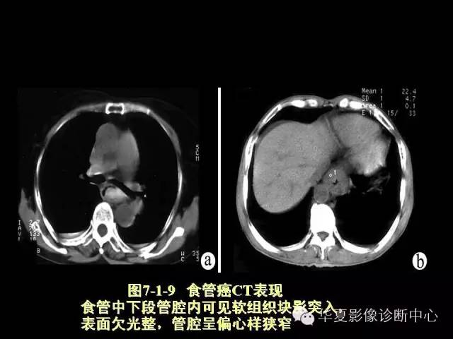 【PPT】食道常见疾病影像诊断