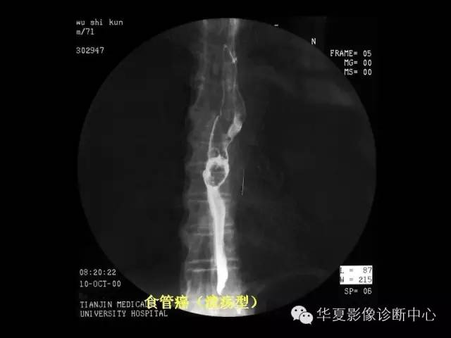 【PPT】食道常见疾病影像诊断