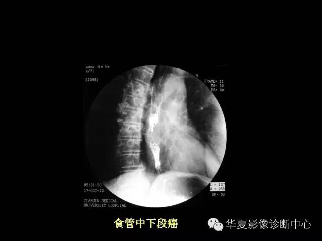 【PPT】食道常见疾病影像诊断