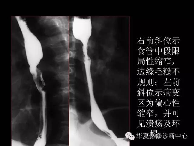 【PPT】食道常见疾病影像诊断