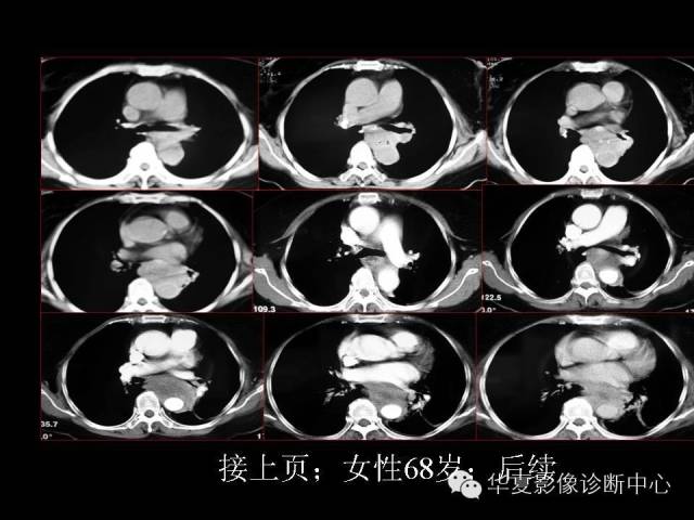 【PPT】食道常见疾病影像诊断