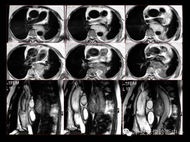 【PPT】食道常见疾病影像诊断