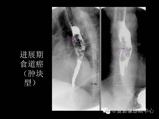【PPT】食道常见疾病影像诊断