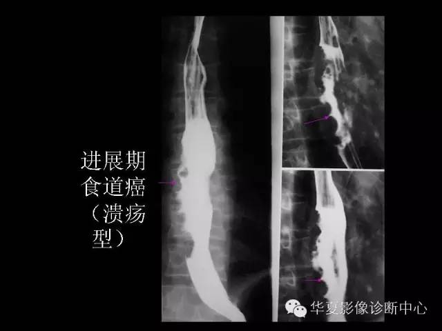 【PPT】食道常见疾病影像诊断