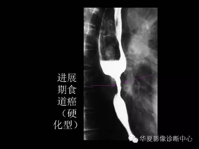 【PPT】食道常见疾病影像诊断