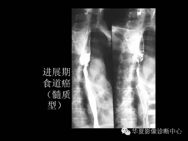 【PPT】食道常见疾病影像诊断