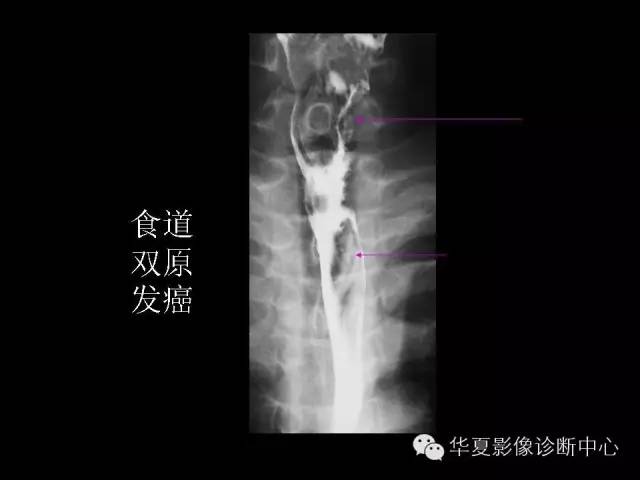 【PPT】食道常见疾病影像诊断