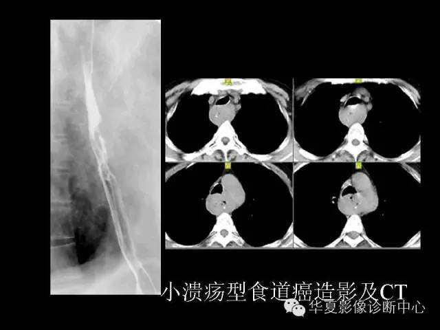 【PPT】食道常见疾病影像诊断