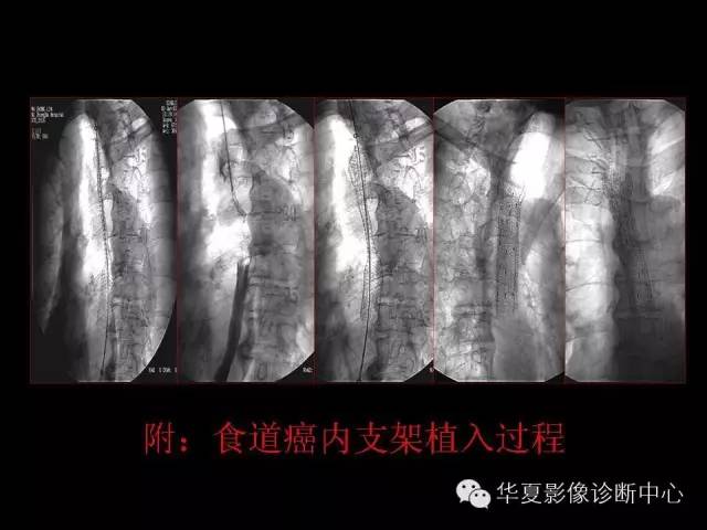 【PPT】食道常见疾病影像诊断