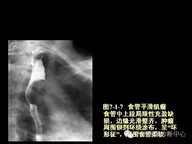 【PPT】食道常见疾病影像诊断