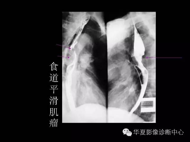 【PPT】食道常见疾病影像诊断