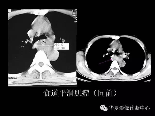 【PPT】食道常见疾病影像诊断