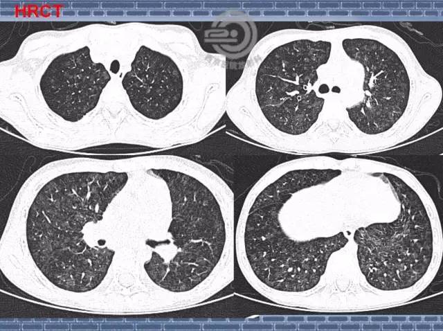 【病例】肺静脉闭塞性疾病1例CT影像表现