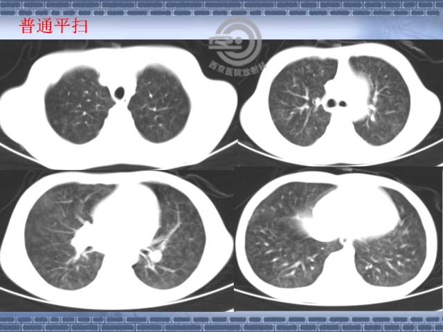 【病例】肺静脉闭塞性疾病1例CT影像表现