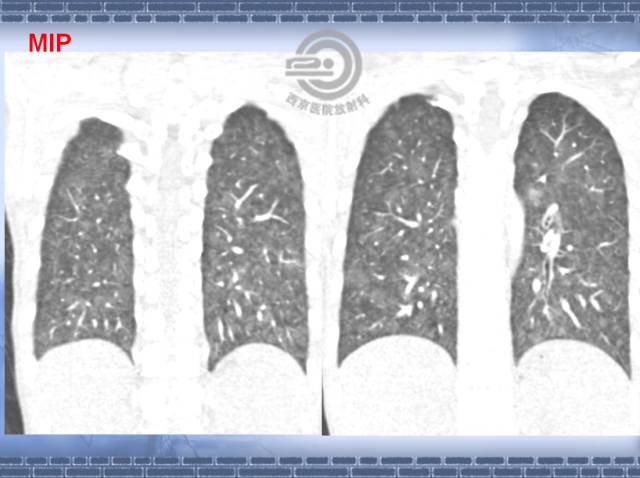 【病例】肺静脉闭塞性疾病1例CT影像表现